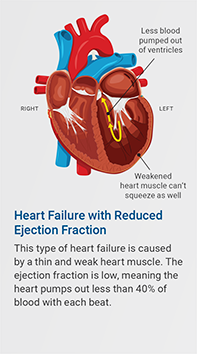 Heart failure with reduced ejection fraction. This type of heart failure is caused by a thin and weak heart muscle. The ejection fraction is low, meaning the heart pumps out less than 40% of blood with each beat.