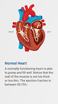 Normal heart. A normally functioning heart is able to pump and fill well. Notice that the wall of the muscle is not too thick or too thin. The ejection fraction is between 55-75%.