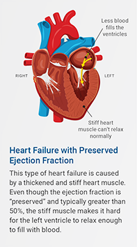 Heart failure with preserved ejection fraction. This type of heart failure is caused by a thickened and stiff heart muscle. Even though the ejection fraction is "preserved" and typically greater than 50%, the stiff muscle makes it hard for the left ventricle to relax enough to fill with blood.