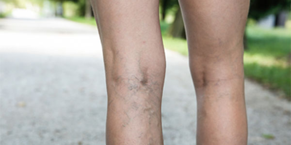 Varicose veins on back of leg